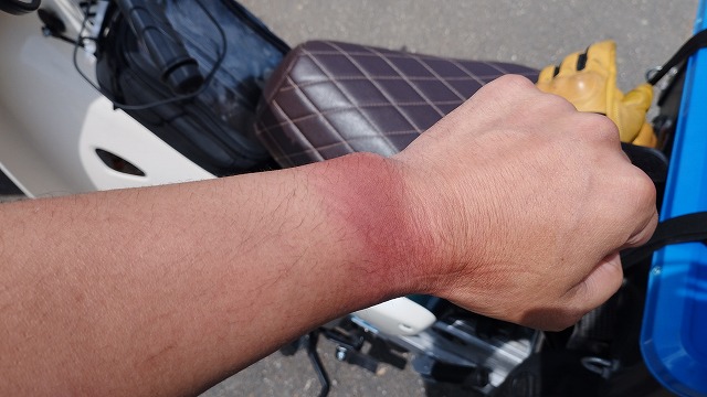 手首だけ異常に日焼けしてしまった筆者の画像